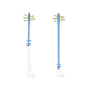 QML Multi-Dimensional Suprapatellar Approach Tibial Intramedullary Nail System • Kangli Orthopedics QML Multi-Dimensional Suprapatellar Approach Tibial Intramedullary Nail System