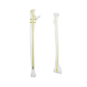 QML Multi-Dimensional Ulna & Radius Intramedullary Nail System • Kangli Orthopedics QML Multi-Dimensional Ulna & Radius Intramedullary Nail System