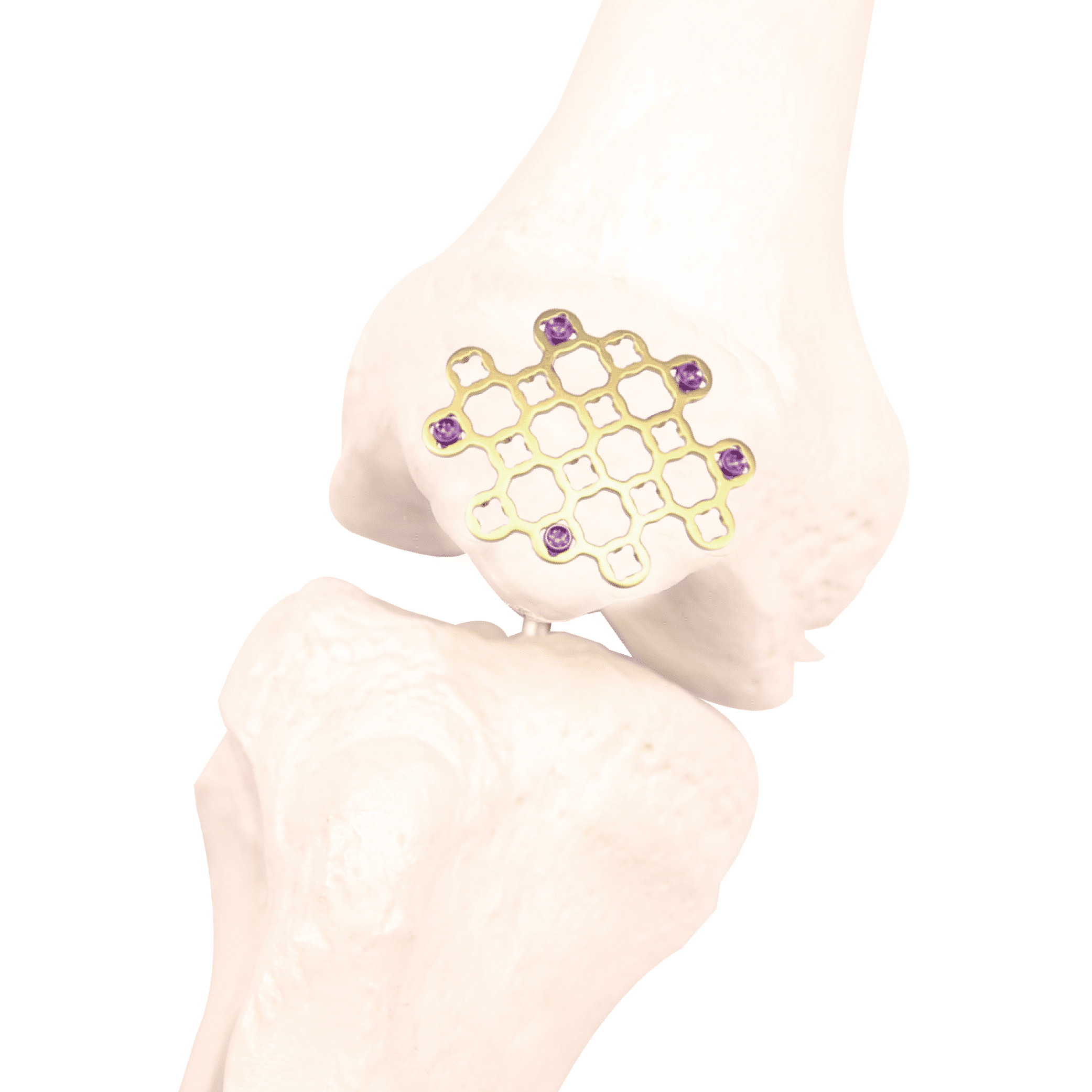 G-2357 • Kangli Orthopedics Variable Angle Patella Locking Plate