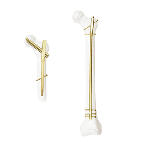 KTO Sliding Compression Gamma Intramedullary Nail System (Asian Version) • Kangli Orthopedics KTO Sliding Compression Gamma Intramedullary Nail System (Asian Version)
