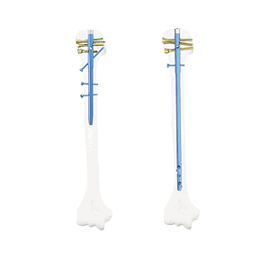 QML Multi-Dimensional Humeral Intramedullary Nail System • Kangli Orthopedics QML Multi-Dimensional Humeral Intramedullary Nail System
