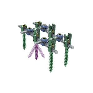 KSS-I 6.0 Spinal Fixation System (Torx) • Kangli Orthopedics KSS-I 6.0 Spinal Fixation System (Torx)