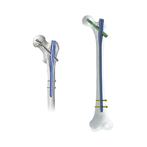 KTO PFNA Gamma Intramedullary Nail System • Kangli Orthopedics KTO PFNA Gamma Intramedullary Nail System